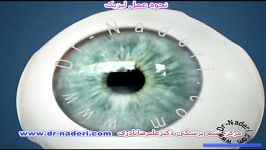 اصلاح آستیگماتیسم عمل آب مروارید مرکز چشم دکترنادری