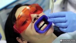 درمان لک زردی دندان سفیدی دندان در ۲۰ دقیقه