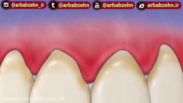 سابلیمینال زیبایی دندان افزایش سفیدی ،ترمیم دندان پوسیدگی