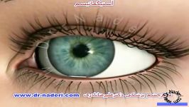 آستیگماتیسم مرکز چشم پزشکی دکتر علیرضا نادری