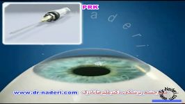 لیزر پی آر کی PRK  مرکز چشم پزشکی دکتر علیرضا نادری