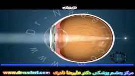 دوربینی  سایت چشم پزشکی دکتر علیرضا نادری