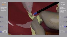 Laparoscopic Cholecystectomy Simulation  Dissection