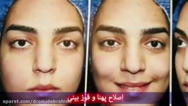 جراحی زیبایی بینی پهن قوزدار توسط دکتر امید ابراهیمی بهترین جراح بینی