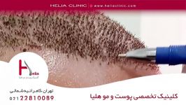 علت ریزش پوسته های روی سر بعد کاشت مو  کلینیک هلیا  02122810089