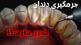 آیا جرمگیری برای دندانها مضر است؟ دکتر افشین کاوسی همراه شوید