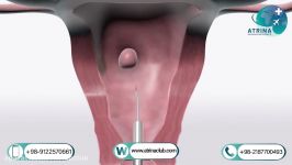 Abdominal Myomectomy in atrina 