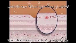 لیزر درمانی در دیابت مرکز چشم پزشکی دکتر علیرضا نادری