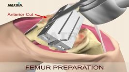 ٰٰعمل تعویض مفصل زانو Total Knee Joint Replacement