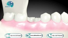  Insertion of bone powder and membrane for up to three teet implant implantation