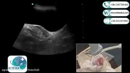 color doppler ultrasound of the uterus and ovary through the vagina in atrina