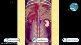  Adrenal ultrasound  unilateral or bilateral in atrina