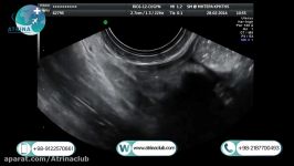 Ultrasound of the salivary glands submandibular parotid