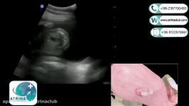  Ultrasound to detect fetal congenital malformations in atrina
