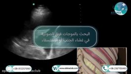  Ultrasound of fluid search in pleura or ascites in atrina