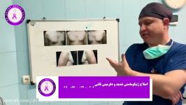 ژنیکوماستی در آقای 30 ساله تکنیک خاص حداقل برش