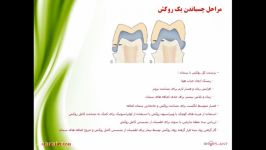 نکات کاربردی در سمان کردن رستوریشن ها