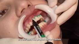 آموزش سفید کردن دندان  ویژه دانشجویان دندان پزشکی