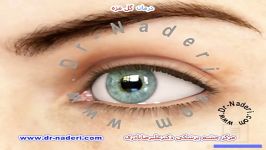 درمان گل مژه  مرکز چشم پزشکی دکتر علیرضا نادری