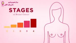 سرطان پستان قسمت یازدهم  مراحل سرطان
