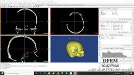 شبیه سازی جمجمه اسیب دیده انسان در نرم افزار میمیکس