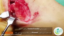 عمل جراحی تاندون ترانسفر Tendon Teansfer به دلیل افتادگی مچ پا Drop Foot 