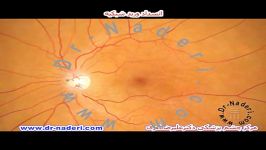 انسداد ورید شبکیه CRVO مرکزچشم پزشکی دکتر علیرضا نادری