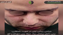 جراحی زیبایی بینی در صورت نامتقارن تیغه بینی سوراخ کج