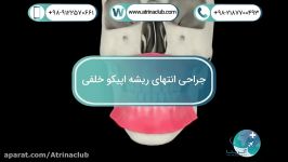 جراحی انتهای ريشه اپيکو خلفی