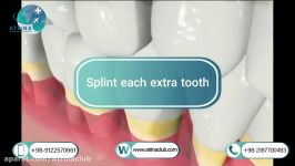 Splint each extra tooth in atrina