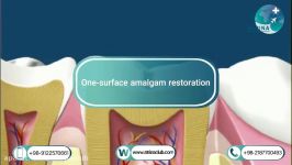 One surface amalgam restoration in atrina