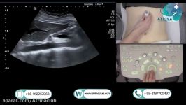 Pancreatic ultrasound in atrina