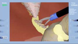 Laparoscopic Cholecystectomy Simulation  Overview