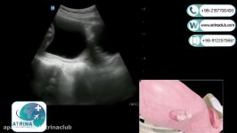 Ultrasound to detect fetal congenital malformations in atrina