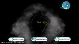 Ultrasound of the breast with axillary spaces with a special probe in atrina