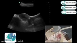 uterus and ovary Ultrasound from the abdomen in atrina