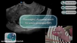 Transvaginal ultrasound search for ectopic pregnancy EP in arina