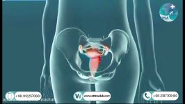 Vaginal hysterectomy in atrina