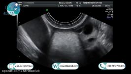 Ultrasound of the salivary glands submandibular parotid in atrina