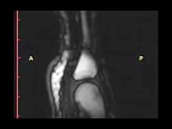 تصویر MRI شکستن قولنج انگشت