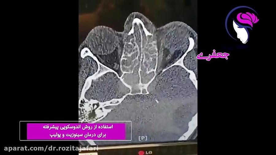 فیلم روش آندوسکوپی پیشرفته برای درمان سینوزیت