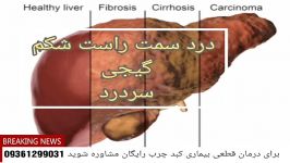 علائم کبد چرب رو بشناسید درمان بشید