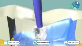 glass ionomer flooring pulp cap in atrina