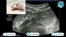 Retroperitoneal ultrasound or non Doppler abdominal aorta in atrina