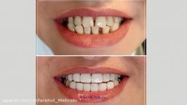فیلم کامپوزیت دندان بستن فاصله بین دندانها