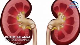 چه عواملی باعث سنگ در کلیه ها میشود؟