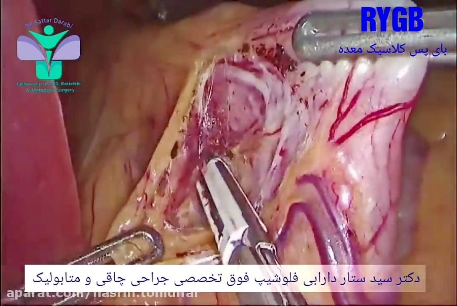 عمل جراحی بای پس کلاسیک معده توسط دکتر سید ستار دارابی