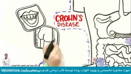 التهاب روده درمان قطعی آن کولیت روده IBD