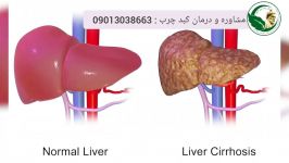 چه افرادی به بیماری کبدچرب مبتلا می شوند؟