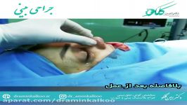 قبل بعد عمل بینی  جراح بینی اصفهان